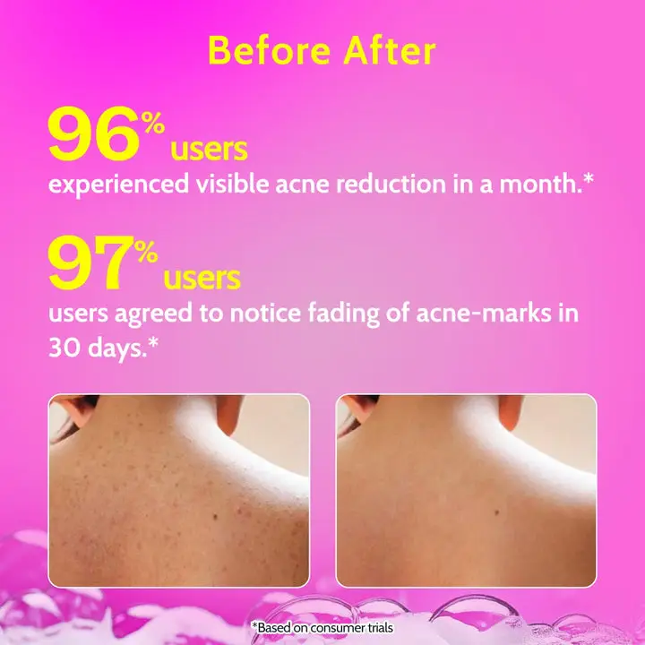 1% Salicylic Acid Body Wash for Acne Control